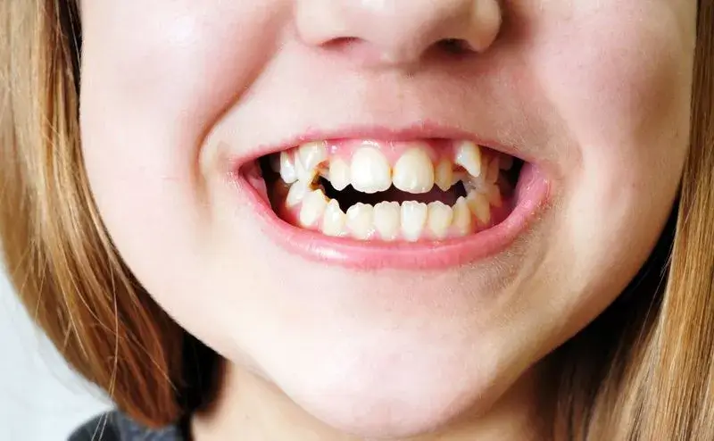 Cómo prevenir y tratar el apiñamiento dental en niños